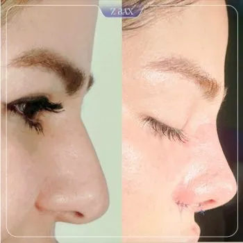 نمونه عمل جراحی بینی دکتر غلامرضا کدخدایی الیادرانی — تصویر 7