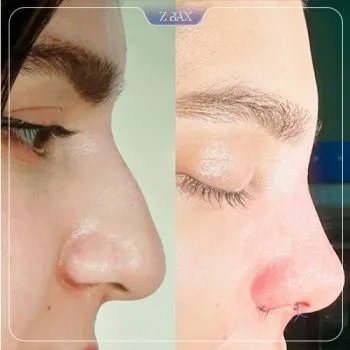 نمونه عمل جراحی بینی دکتر غلامرضا کدخدایی الیادرانی — تصویر 8