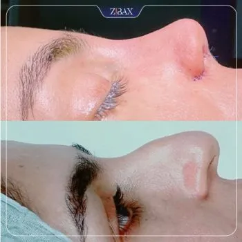 نمونه عمل جراحی بینی دکتر غلامرضا کدخدایی الیادرانی — تصویر 2