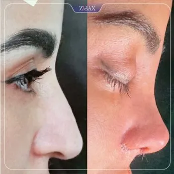 نمونه عمل جراحی بینی دکتر غلامرضا کدخدایی الیادرانی — تصویر 3