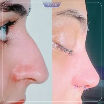 نمونه عمل جراحی بینی دکتر غلامرضا کدخدایی الیادرانی — تصویر 4