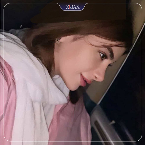 نمونه عمل جراحی بینی دکتر سپیده آتشی — تصویر 5