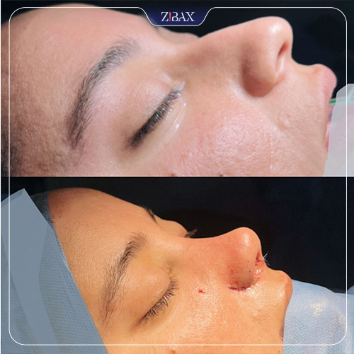 نمونه عمل جراحی بینی دکتر سپیده آتشی — تصویر 10