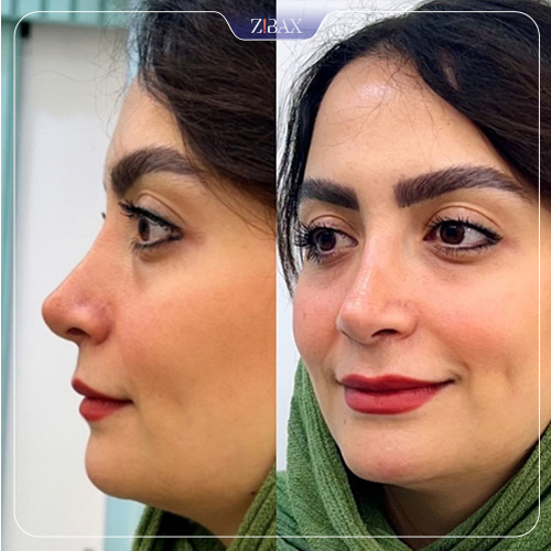 نمونه عمل جراحی بینی دکتر سپیده آتشی — تصویر 1