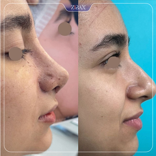 نمونه عمل جراحی بینی دکتر سپیده آتشی — تصویر 3