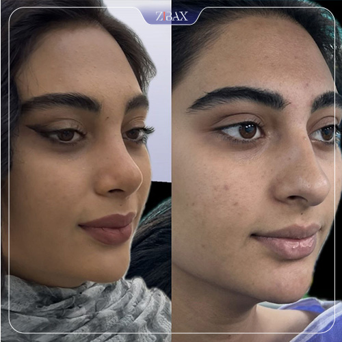 نمونه عمل جراحی بینی دکتر سپیده آتشی — تصویر 4