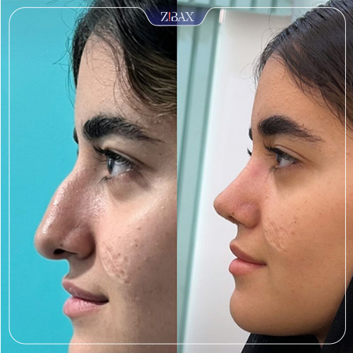 نمونه عمل جراحی بینی دکتر سپیده آتشی — تصویر 6