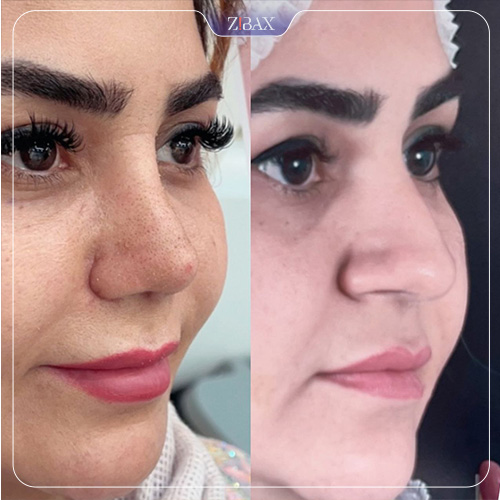 نمونه عمل جراحی بینی دکتر سپیده آتشی — تصویر 7