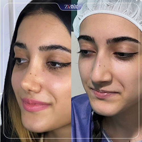 نمونه عمل جراحی بینی دکتر سپیده آتشی — تصویر 8