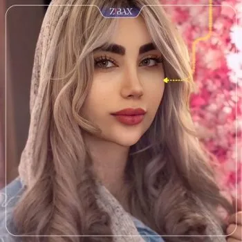 نمونه عمل جراحی بینی دکتر امیرحسین محمدی مفرد — تصویر 7