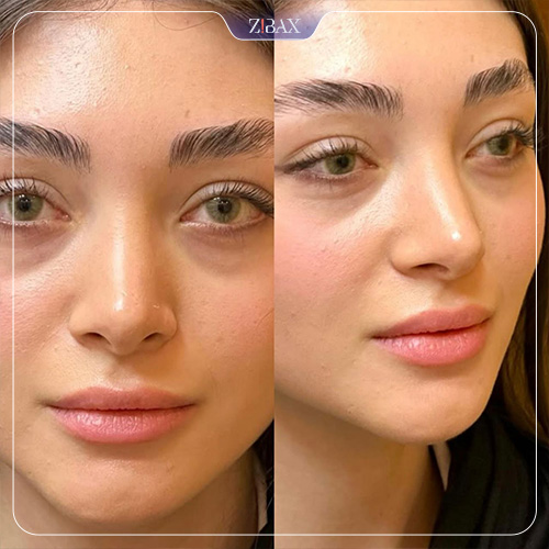 نمونه عمل جراحی بینی دکتر حمیدرضا نوری — تصویر 3
