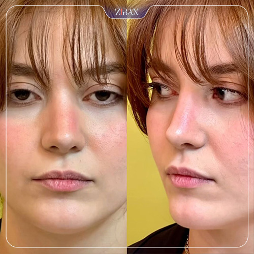 نمونه عمل جراحی بینی دکتر حمیدرضا نوری — تصویر 4