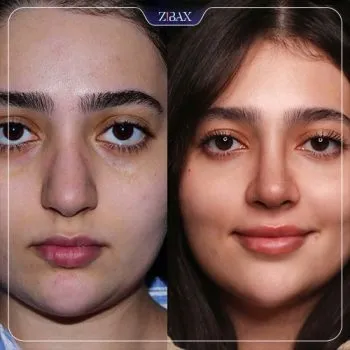 نمونه عمل جراحی بینی دکتر محمد مجیدی — تصویر 6