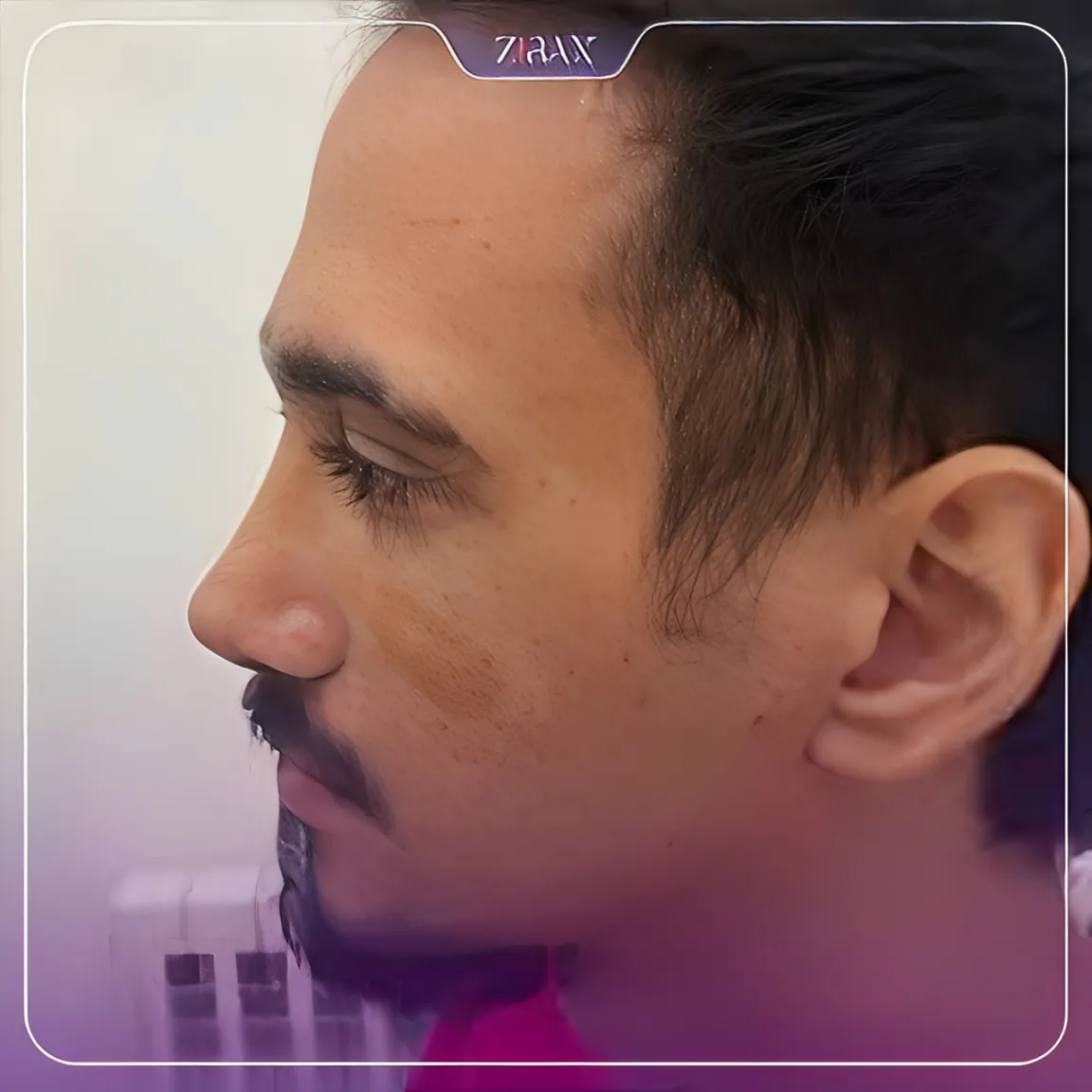 نمونه عمل جراحی بینی دکتر رضا ساریخانی — تصویر 7