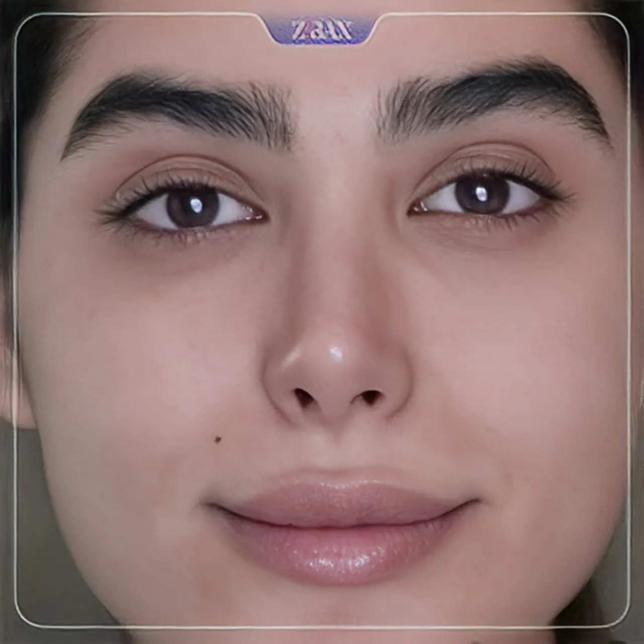 نمونه عمل جراحی بینی دکتر رضا ساریخانی — تصویر 4