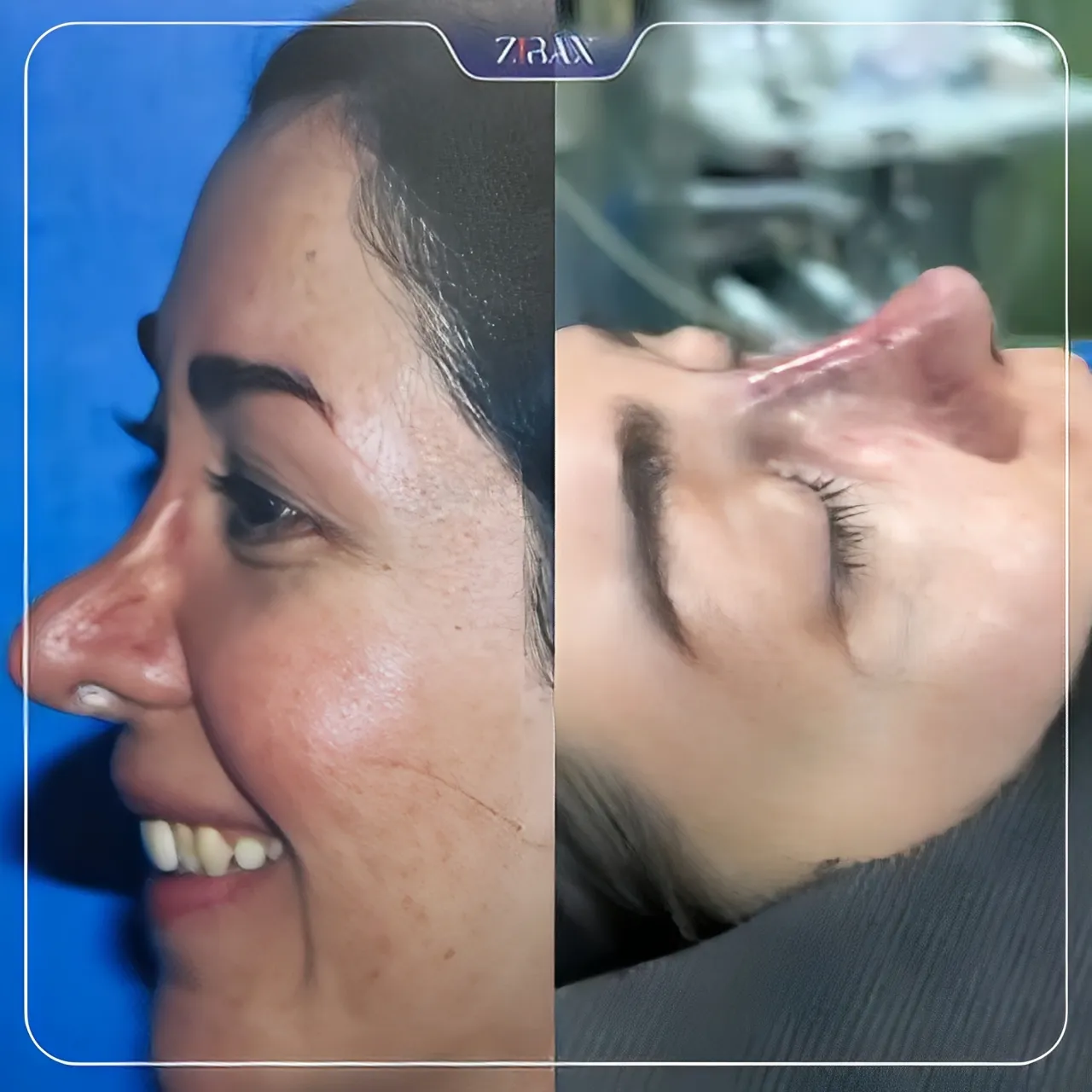 نمونه عمل جراحی بینی دکتر رضا ساریخانی — تصویر 5