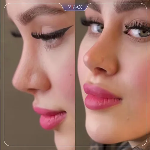 نمونه عمل جراحی بینی دکتر اسدالله مهدوی — تصویر 2