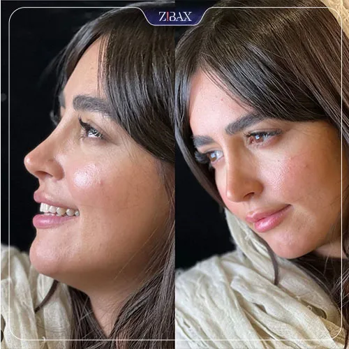 نمونه عمل جراحی بینی دکتر اسدالله مهدوی — تصویر 10
