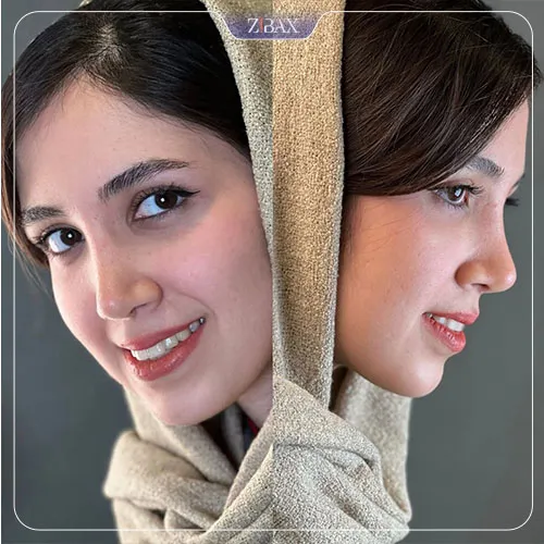 نمونه عمل جراحی بینی دکتر اسدالله مهدوی — تصویر 9