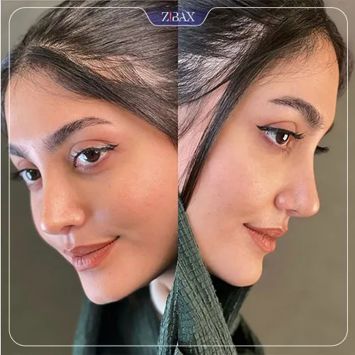 نمونه عمل جراحی بینی دکتر اسدالله مهدوی — تصویر 4
