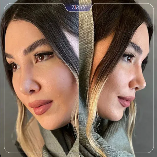 نمونه عمل جراحی بینی دکتر اسدالله مهدوی — تصویر 5
