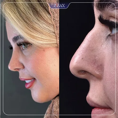 نمونه عمل جراحی بینی دکتر اسدالله مهدوی — تصویر 1