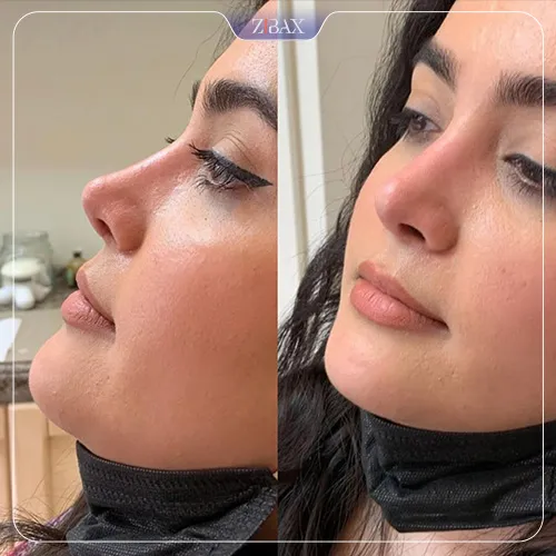 نمونه عمل جراحی بینی دکتر حمیدرضا نوری — تصویر 12