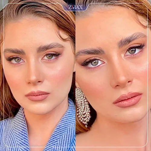 نمونه عمل جراحی بینی دکتر حمیدرضا نوری — تصویر 13