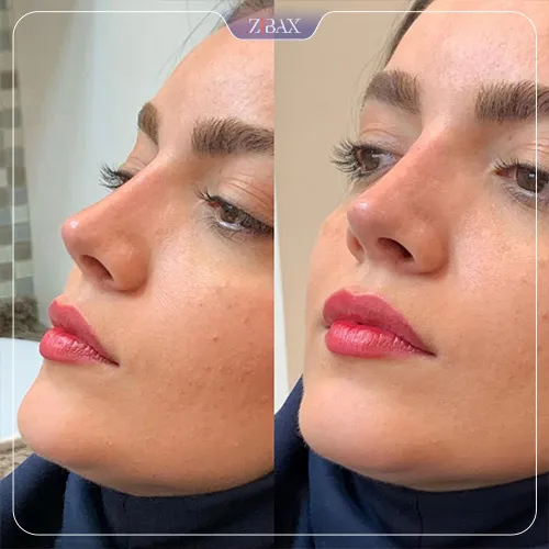 نمونه عمل جراحی بینی دکتر حمیدرضا نوری — تصویر 10