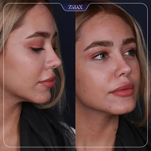 نمونه عمل جراحی بینی دکتر حمیدرضا نوری — تصویر 11
