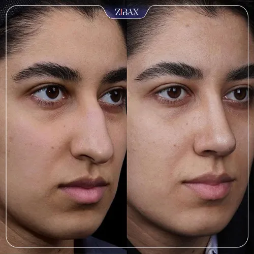 نمونه عمل جراحی بینی دکتر شاهین باستانی نژاد — تصویر 1