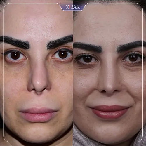 نمونه عمل جراحی بینی دکتر شاهین باستانی نژاد — تصویر 2