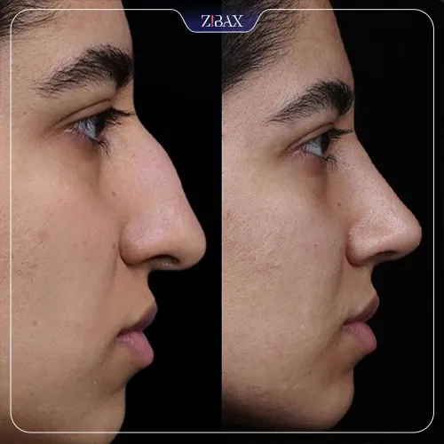 نمونه عمل جراحی بینی دکتر شاهین باستانی نژاد — تصویر 10