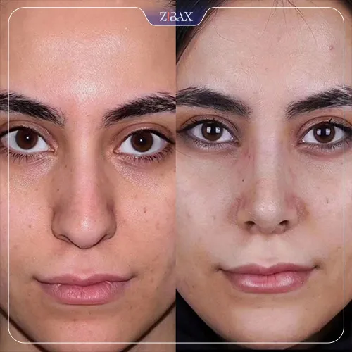 نمونه عمل جراحی بینی دکتر شاهین باستانی نژاد — تصویر 9