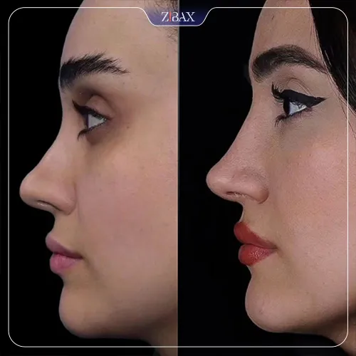نمونه عمل جراحی بینی دکتر شاهین باستانی نژاد — تصویر 8