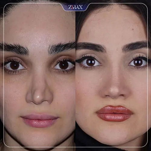 نمونه عمل جراحی بینی دکتر شاهین باستانی نژاد — تصویر 7