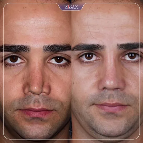 نمونه عمل جراحی بینی دکتر شاهین باستانی نژاد — تصویر 5