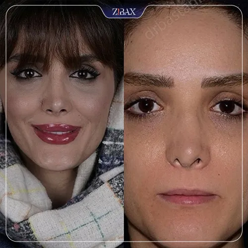 نمونه عمل جراحی بینی دکتر شاهین باستانی نژاد — تصویر 4