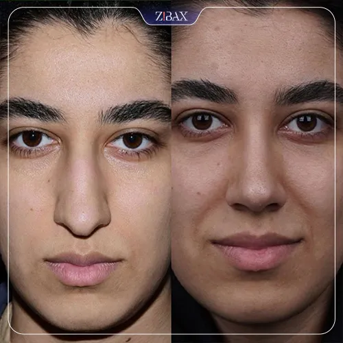 نمونه عمل جراحی بینی دکتر شاهین باستانی نژاد — تصویر 3