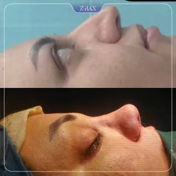 نمونه عمل جراحی بینی دکتر سعدالله صمدی — تصویر 6