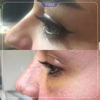 نمونه عمل جراحی بینی دکتر سعدالله صمدی — تصویر 7
