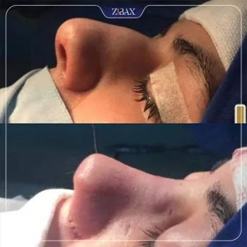 نمونه عمل جراحی بینی دکتر سعدالله صمدی — تصویر 8