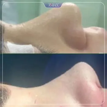 نمونه عمل جراحی بینی دکتر سعدالله صمدی — تصویر 1