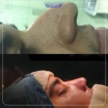 نمونه عمل جراحی بینی دکتر سعدالله صمدی — تصویر 2