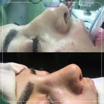 نمونه عمل جراحی بینی دکتر سعدالله صمدی — تصویر 3