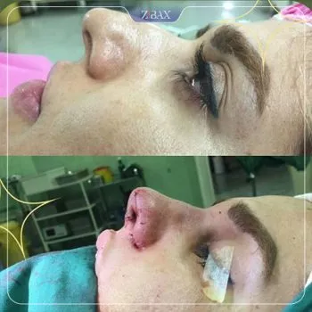نمونه عمل جراحی بینی دکتر سعدالله صمدی — تصویر 4