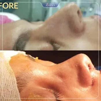 نمونه عمل جراحی بینی دکتر سعدالله صمدی — تصویر 5