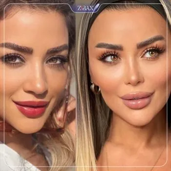 نمونه عمل جراحی بینی دکتر علیرضا کامیابی — تصویر 10