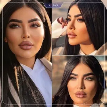 نمونه عمل جراحی بینی دکتر مهرداد نادریان — تصویر 1