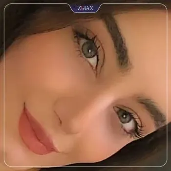 نمونه عمل جراحی بینی دکتر شاهین میلانی — تصویر 7